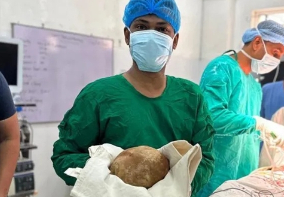 신생아 몸무게만한 3.1kg 타조알 결석이 방광에서 나온 기괴한 사건