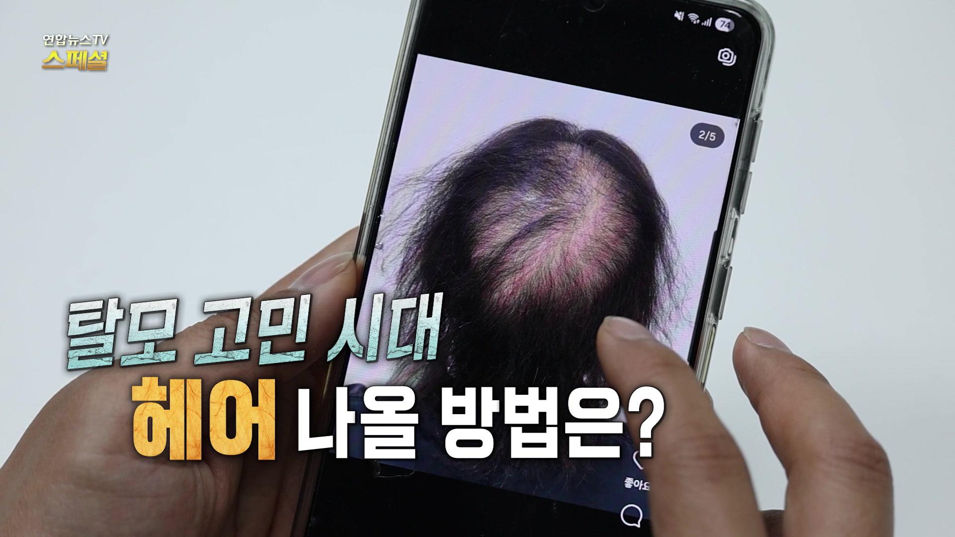 탈모 고민 시대, 헤어 나올 방법은?